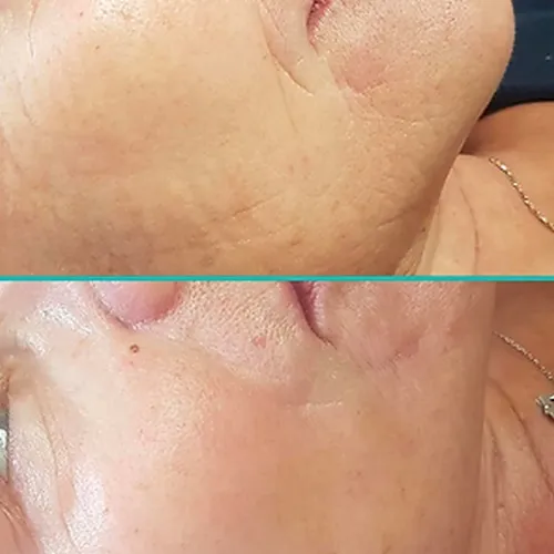 Cure anti-âge, Menton, Dermaligne