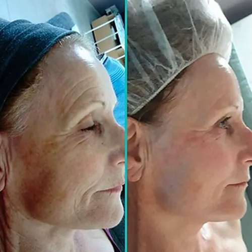 Cure anti-âge, Menton, Dermaligne