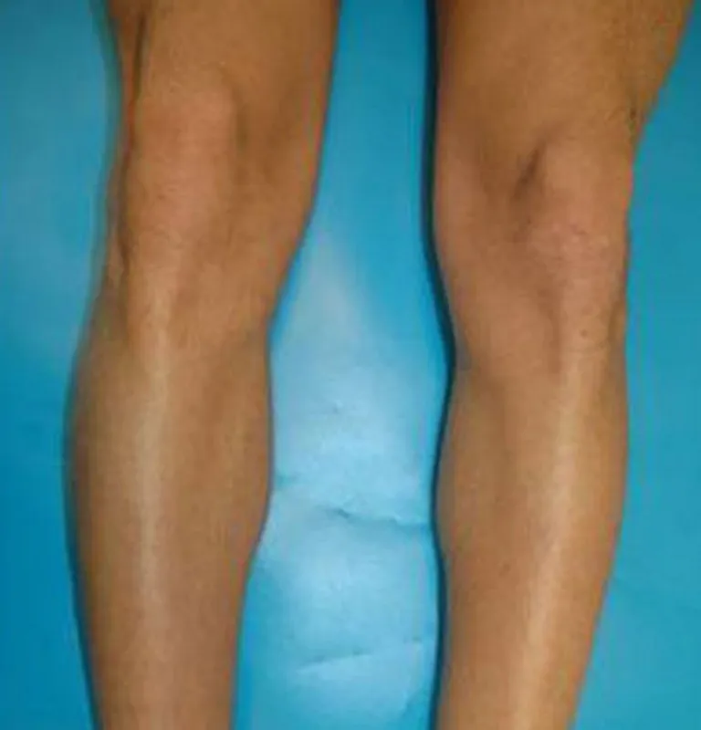 Épilation définitive des jambes, Menton, Dermaligne