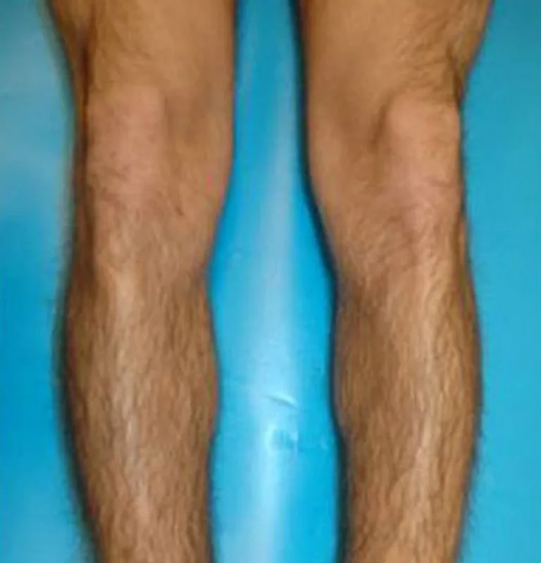 Épilation définitive des jambes, Menton, Dermaligne